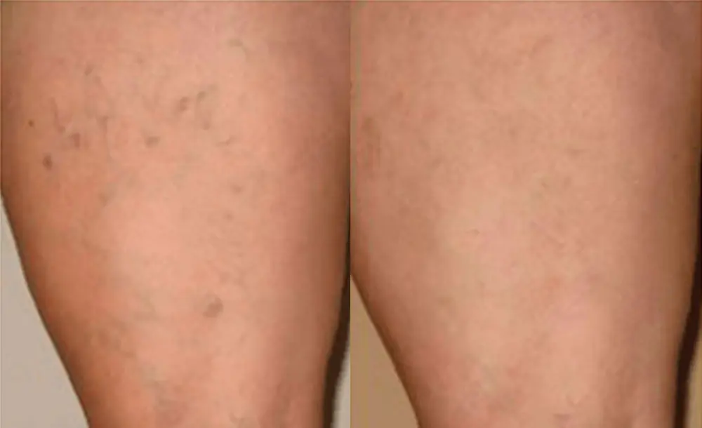 laser vein treatment thighs