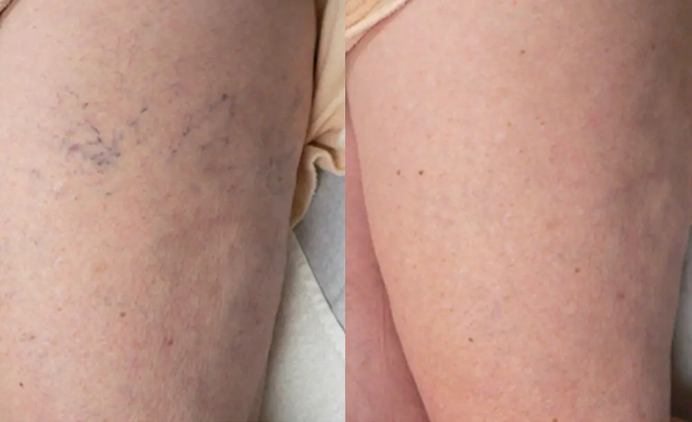 laser vein treatment thighs patient 2