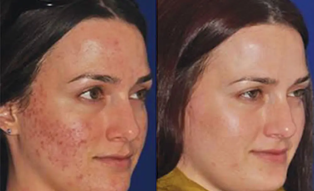 microneedling before and after womans face