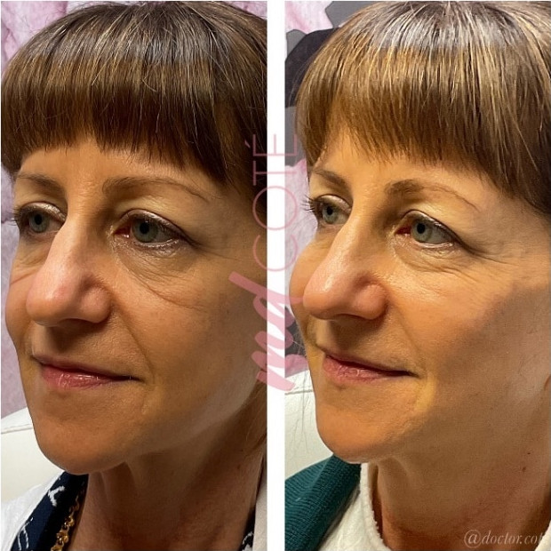 cheek filler before and after side view