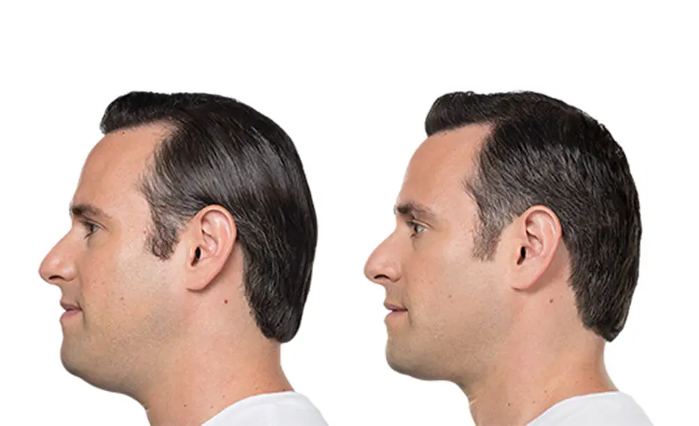 kybella before and after male