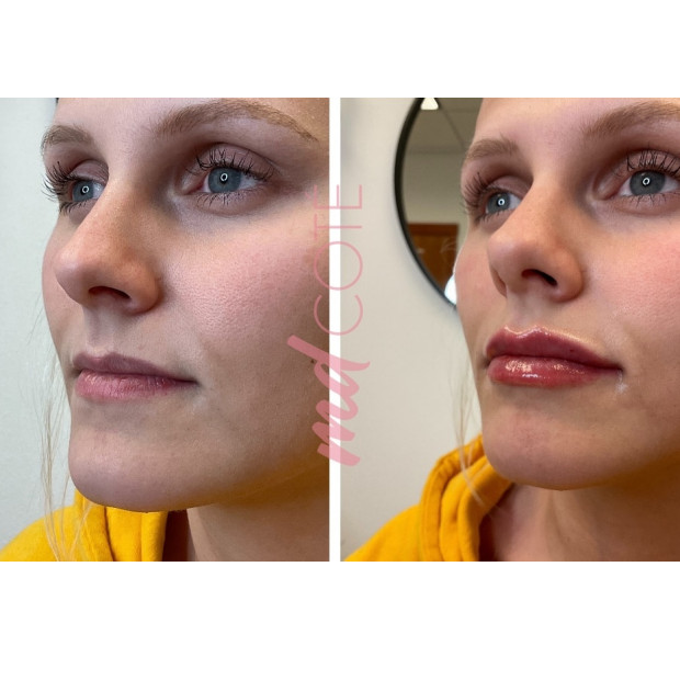 lip filler before and after