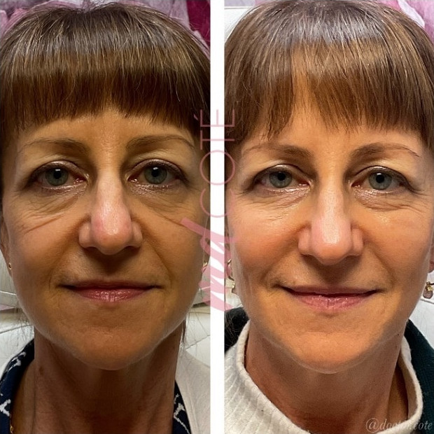 mid face filler before and after