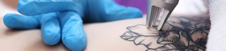 WHAT YOU NEED TO KNOW ABOUT TATTOO REMOVAL