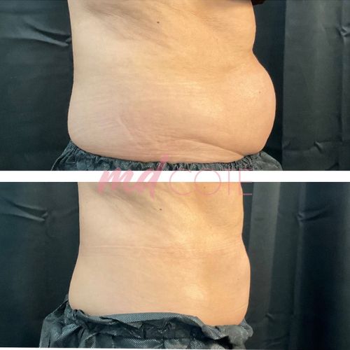 coolsculpting-elite-stomach-before-and-after
